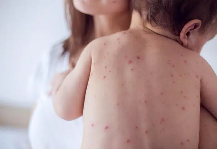 FBiH: Epidemija ospica ubrzano se širi, povećan i broj hripavca Fbih Epidemija Ospica Ubrzano Se Siri Povecan I Broj Hripavca